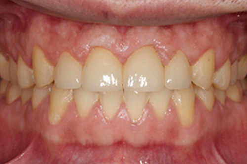 The image shows a close-up of a person's teeth with visible yellow staining, indicative of nicotine use.
