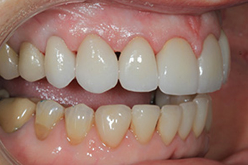 The image shows a close-up of a person s teeth, with the focus on a set of white, straight teeth.