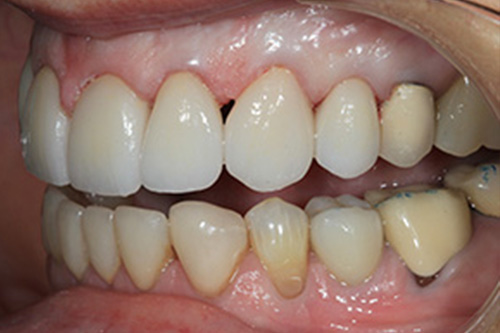 The image shows a close-up of an open mouth with a set of white teeth, revealing a dental implant and gumline.