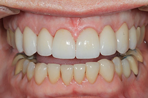 A close-up of a person s bright white teeth, showcasing a clean and healthy smile.