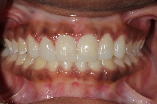 The image shows a close-up of a person s teeth with yellowing and staining, possibly indicating poor oral hygiene or the need for professional dental care.