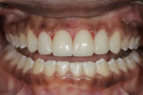 The image shows a close-up of a person s teeth, with the focus on the front teeth and upper lip area.