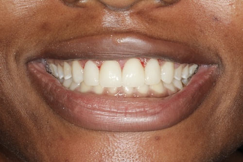 The image shows a close-up of a person smiling, revealing their teeth, with the focus on oral hygiene.