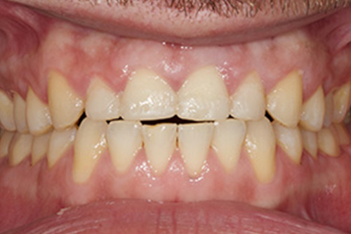 The image shows a close-up of a person's mouth with a set of yellowed teeth, some of which are missing.