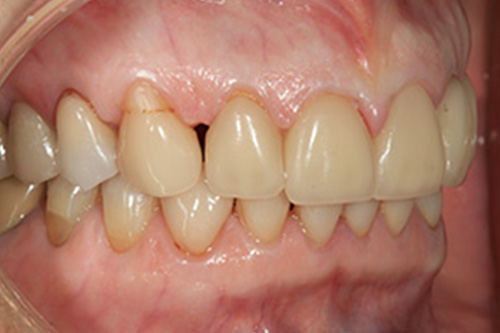 The image shows a close-up of a person s mouth with teeth, including an upper front tooth that is missing.