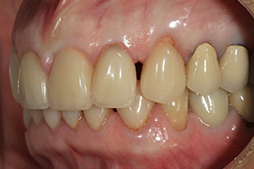 The image shows a close-up of a person's mouth with teeth that appear to be in poor condition, likely due to advanced decay or gum disease.