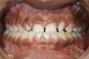 A close-up view of a person s mouth with yellowed teeth, showcasing a large gap between the upper and lower front teeth.
