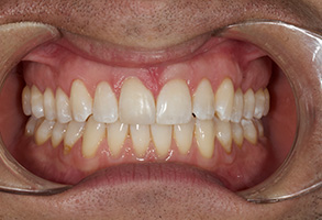 The image shows a person wearing a dental appliance with a wide smile, revealing straight white teeth.