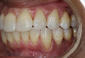 The image features a close-up of an open mouth with a set of teeth, showcasing the upper and lower dental arch.