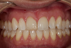 A close-up view of an individual s teeth and upper lip, showcasing a bright smile with pinkish gums.