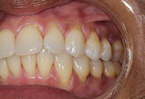 The image shows a close-up of an open mouth with visible teeth, including yellowing and staining, indicating poor oral hygiene.
