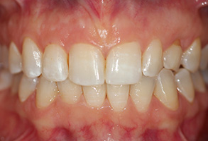 A close-up of a person s mouth with crooked, yellowed teeth and a missing front tooth.