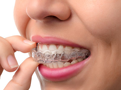An adult woman is seen brushing her teeth with a transparent dental appliance.