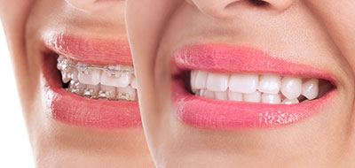 A close-up image of a person s smiling face, with a focus on their teeth and lips.