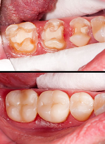 The image shows a close-up of a person s mouth with teeth that appear to be in poor condition, possibly due to decay or neglect.