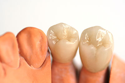 A close-up of two artificial teeth, one with a yellowed crown and the other with a clear crown, set against a white background.