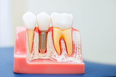 The image shows a dental mold with multiple teeth set into it, including some that appear to be missing their roots or have been modified.