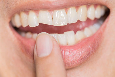 A person with a wide smile showing their teeth, holding a finger near their mouth.