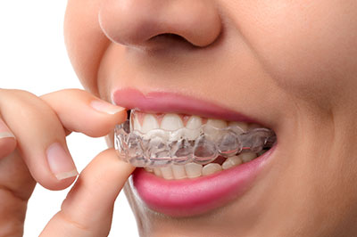 An adult female with a straight, white smile, wearing clear braces and holding a toothpaste tube near her mouth.