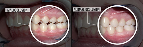 The image shows a comparison of two dental implants, with one appearing to be in the process of integration into the jaw.