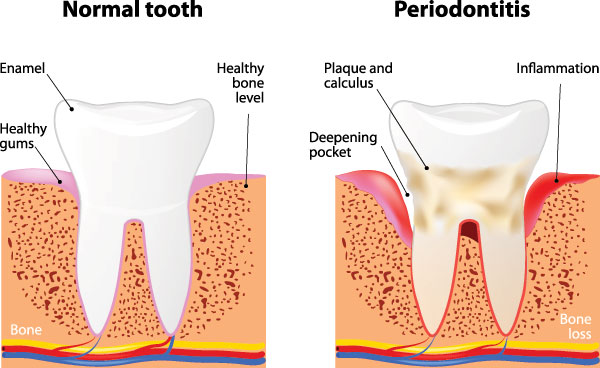 The image is a detailed scientific diagram illustrating the process of normal tooth decay and gum disease, with annotations explaining the different stages.