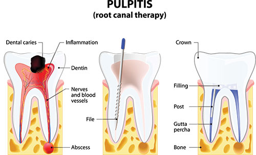 The image is a medical illustration showing the internal structure of a tooth, including its roots and pulp chamber, with annotations indicating various parts such as the root canal therapy process, dental caries, inflammation, and a filling. It also features a magnified view of a cross-section of a tooth with fillings and an infection site.