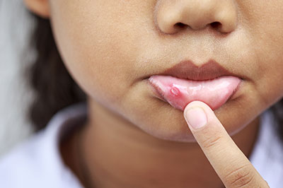 A young person with a finger on their lips, examining an area of skin with a rash or irritation.