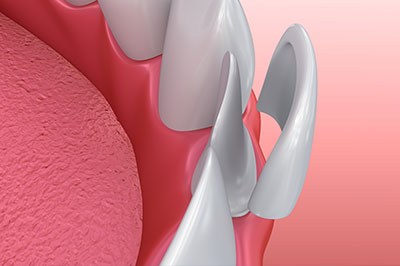 The image shows a close-up of a dental implant with visible screws, set against a pink background that resembles gum tissue.