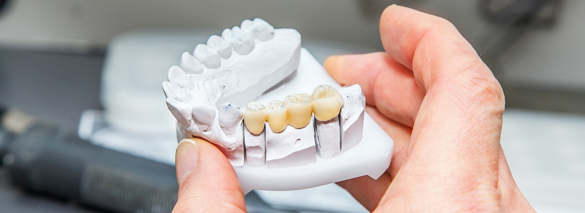 The image shows a person s hand holding a 3D printed dental implant, with the implant partially assembled and showing its structure.