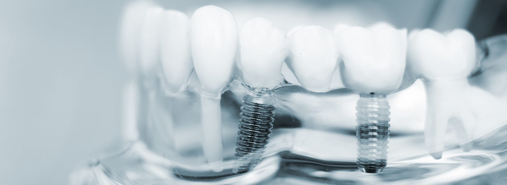 An image of a close-up view of multiple dental implants with screws, showcasing a dental prosthesis.