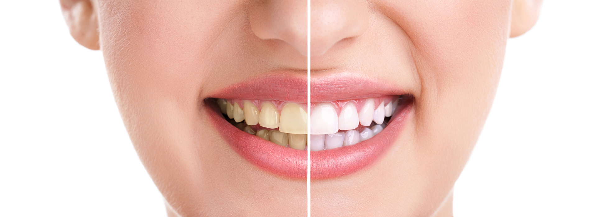 A close-up image of a person s face with a focus on their teeth, showcasing a smile and highlighting dental work.